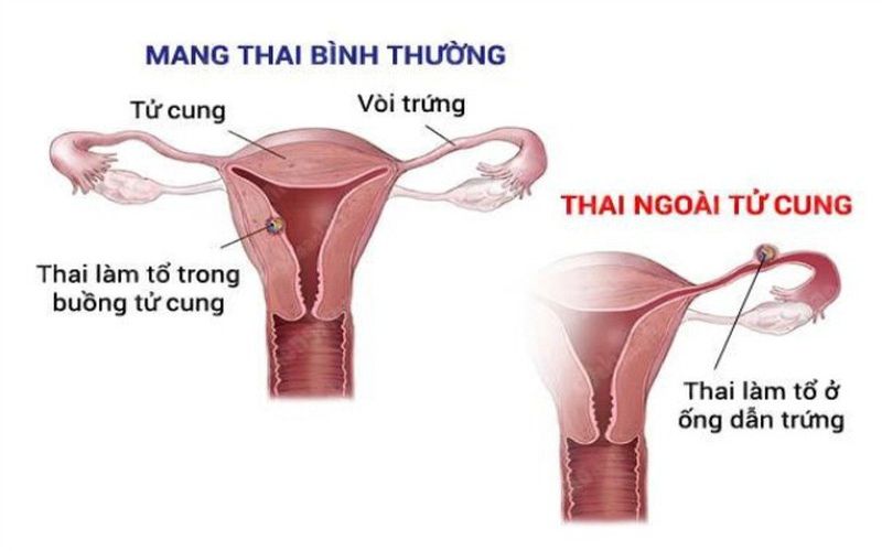 Hình 4: Tắc vòi trứng có thể dẫn đến mang thai ngoài tử cung