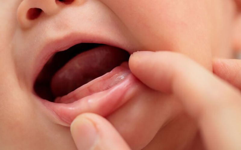 Hình 4: Trẻ thiếu canxi có thể chậm mọc răng, răng mọc không đều