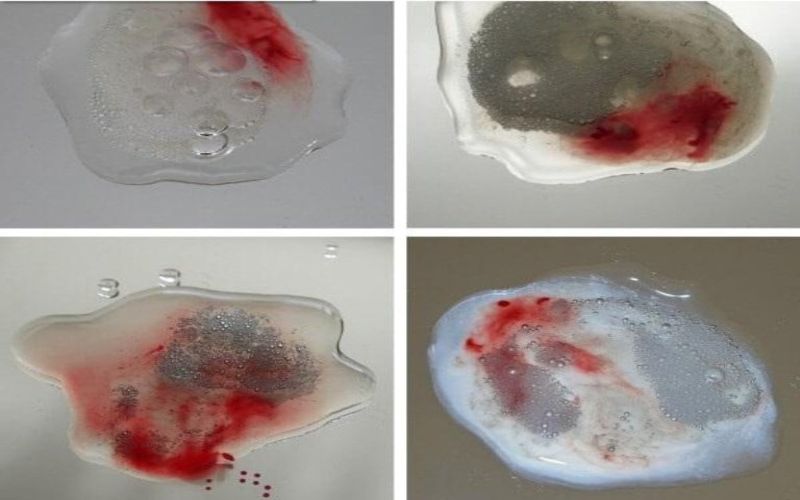 Hình 1: Xuất tinh ra máu trong tinh dịch có màu hồng, đỏ, hoặc tia máu nhỏ
