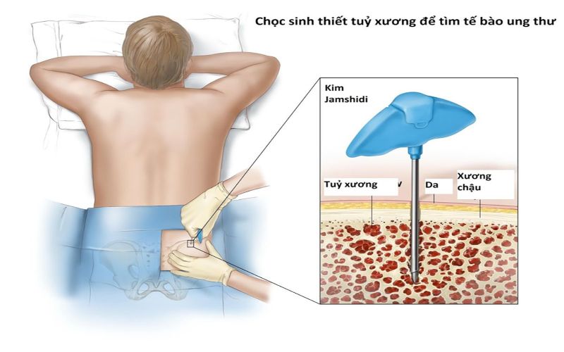 Hình 2: Xét nghiệm sinh thiết giúp bác sĩ chẩn đoán chính xác tình trạng bệnh